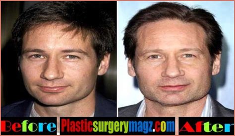 David Duchovny Plastic Surgery Before and After
