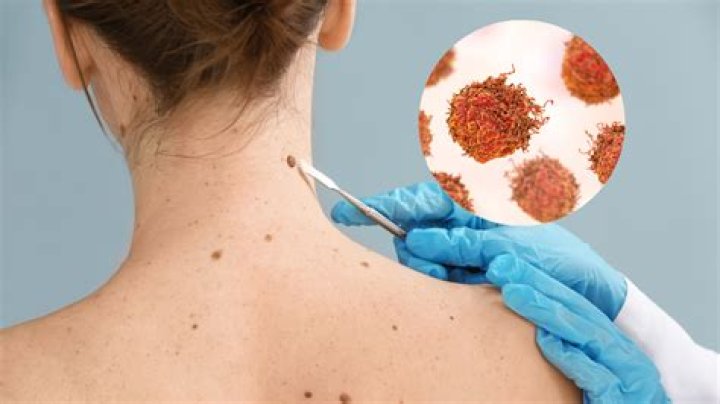 Are verrucas caused by HPV?