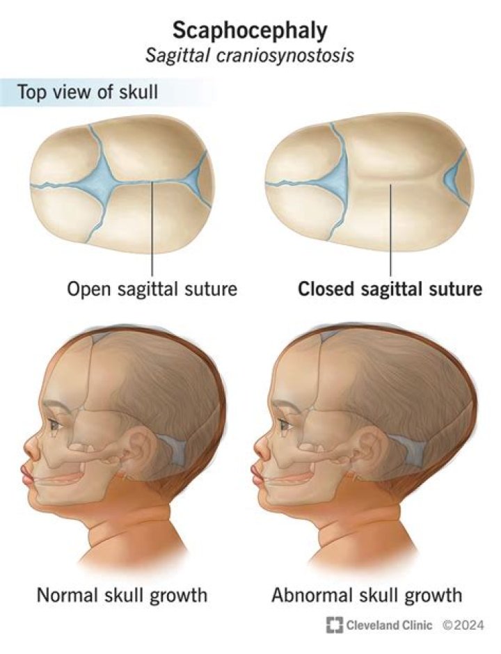 At what age is craniosynostosis diagnosed?