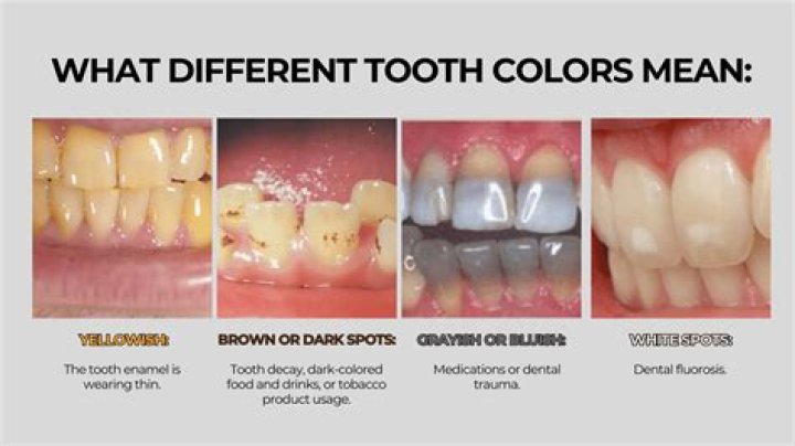 Can a discolored tooth be whitened?