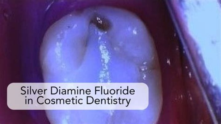 Can adults use silver diamine fluoride?