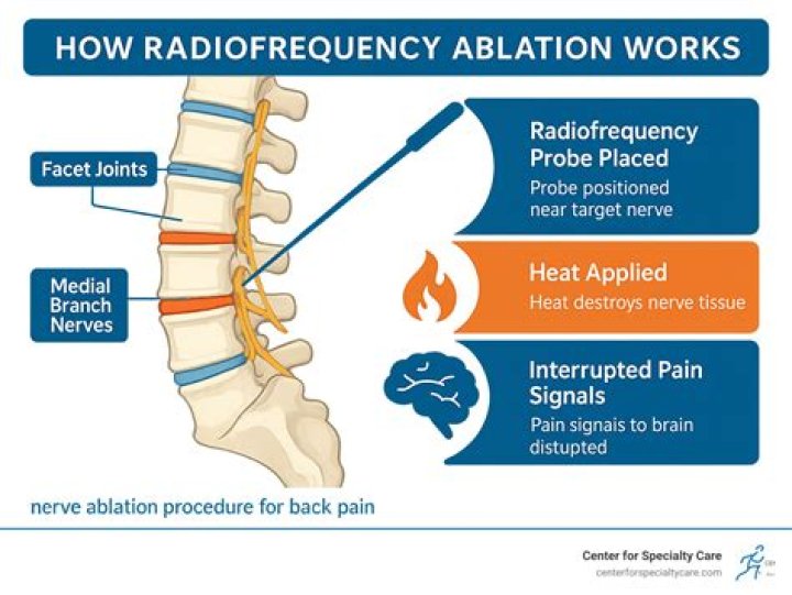 Can an ablation stop working?