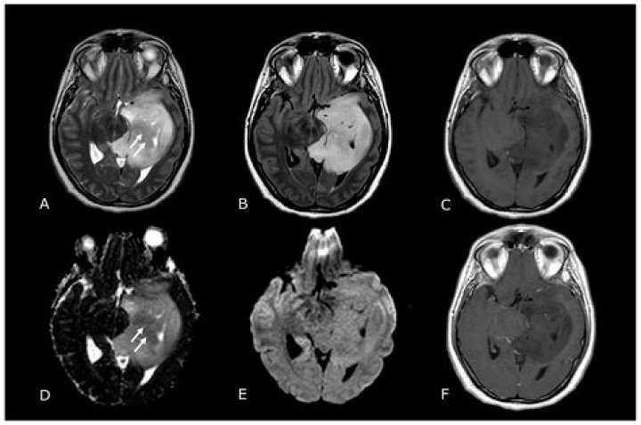 Can depression show up on MRI?