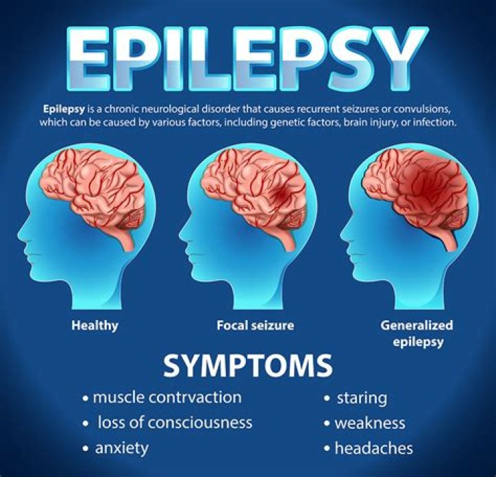 Can epilepsy be caused by stress?