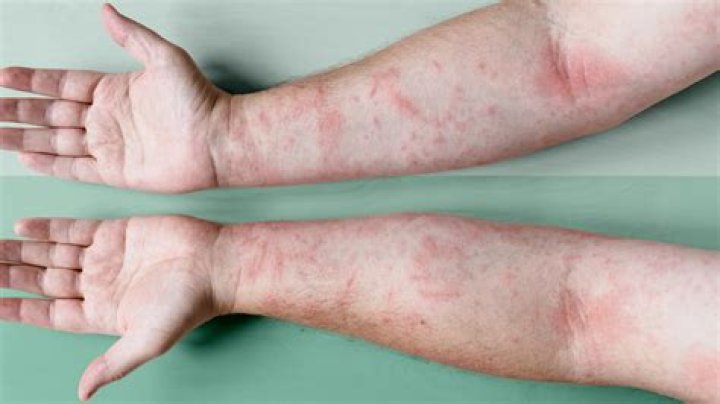 Can I slap eczema?