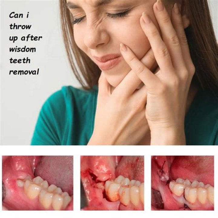 Can I swallow my saliva after wisdom teeth removal?