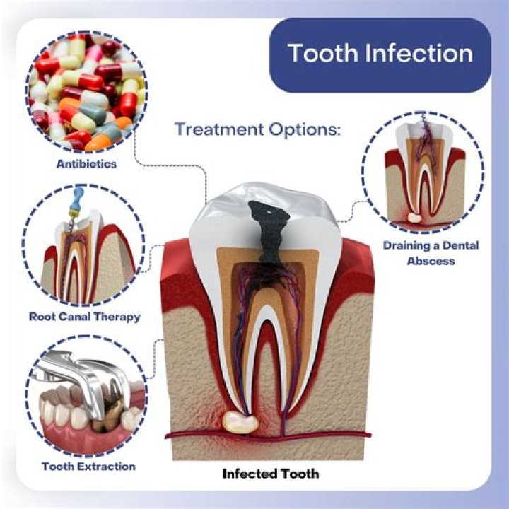 Can I take ciprofloxacin for a tooth infection?