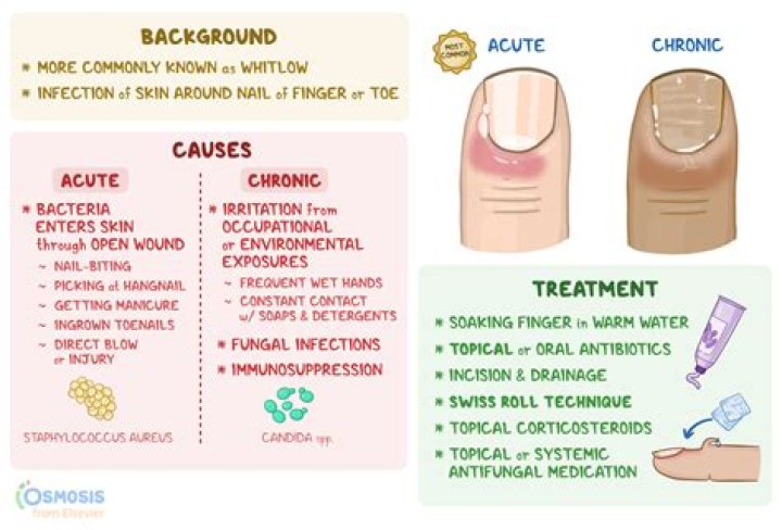 Can ingrown toenail cause sepsis?