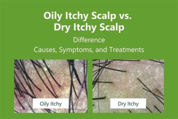 Can itchy scalp feel like lice?