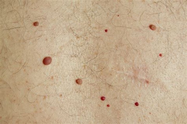Can melanoma be red and itchy?