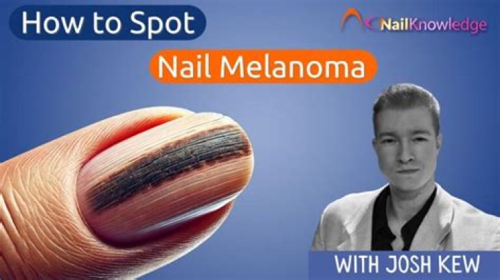 Can melanoma heal itself?
