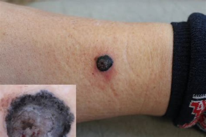 Can melanoma look like a scab?