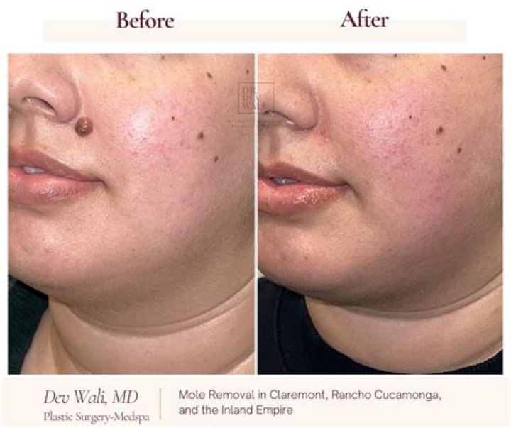 Can melanoma spread after mole removal?