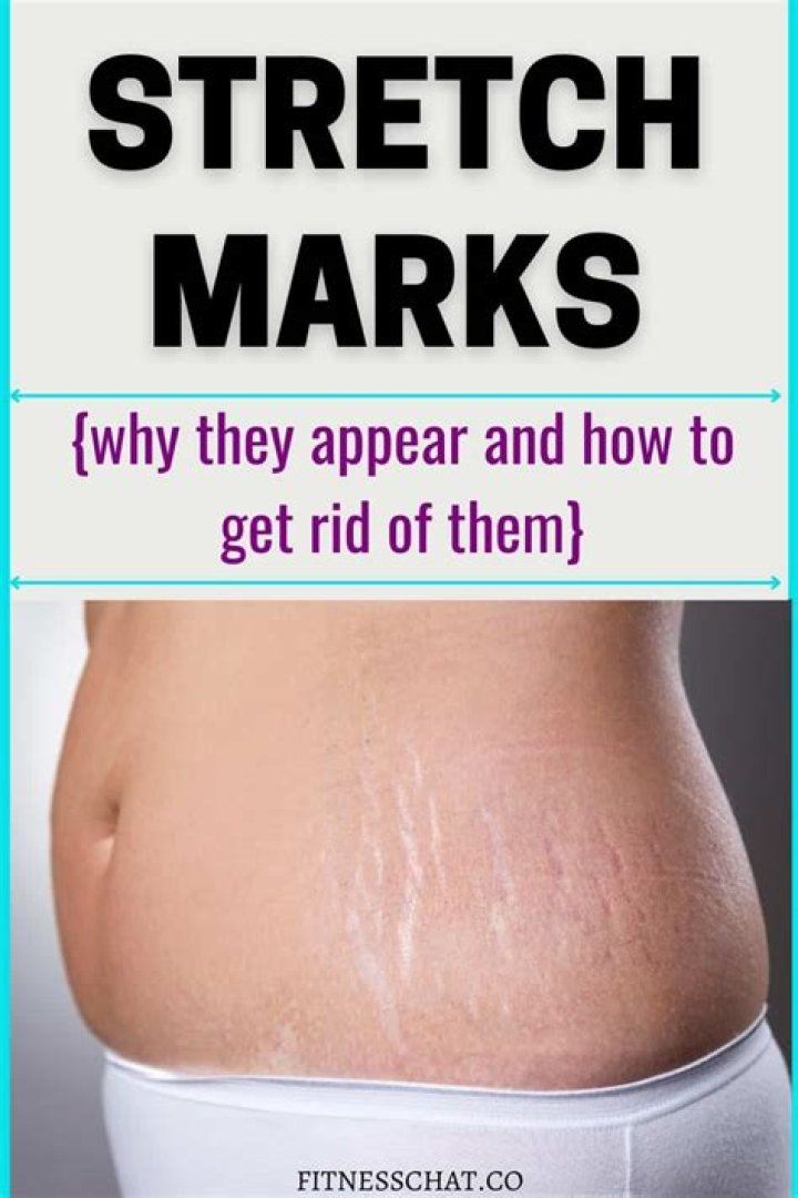 Can stretch marks get bigger?
