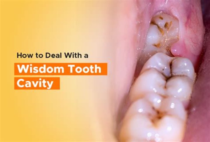 Can wisdom teeth be left alone?