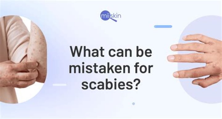 Can you feel scabies walking on you?