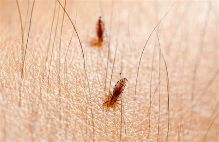 Can you get body lice from not showering?