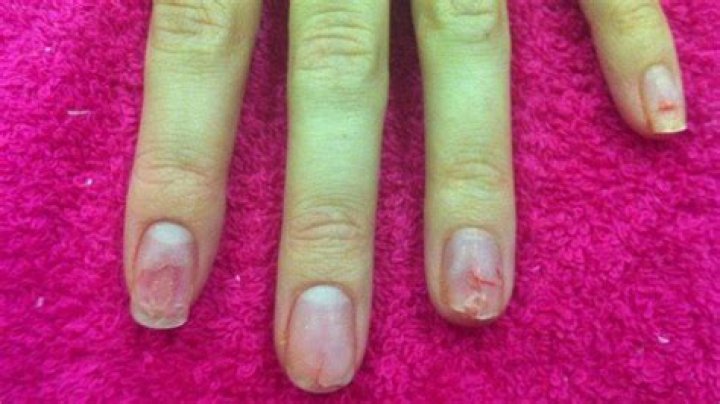 Can you permanently damage your nails?