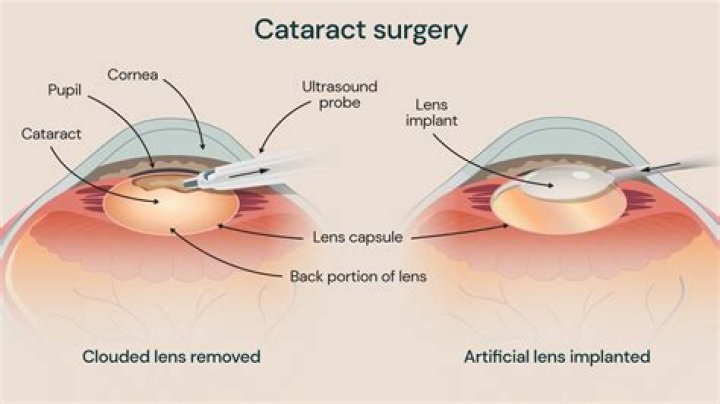 Can you talk during cataract surgery?