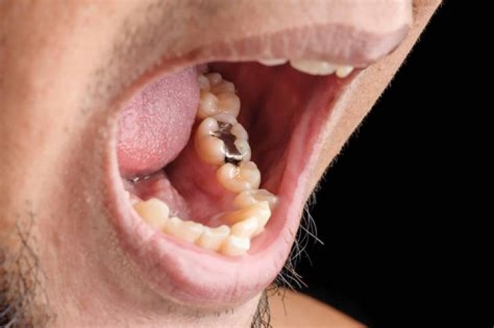 Do dentists still use mercury?