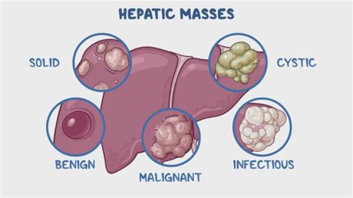 Does a solid mass mean cancer?