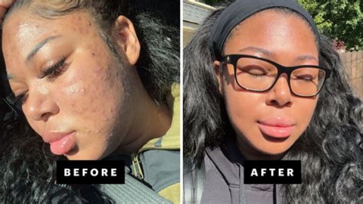 Does accutane work for black people?