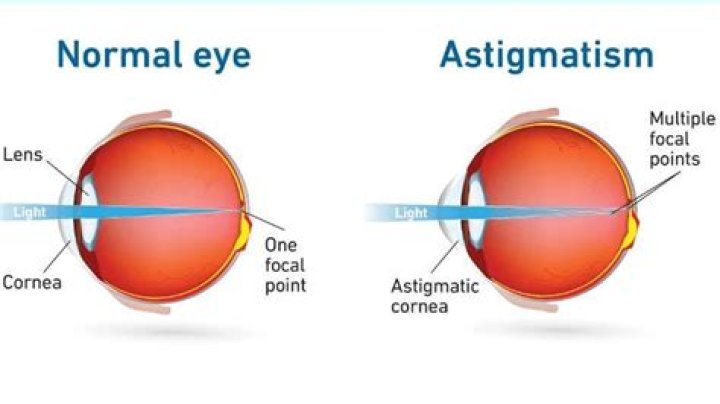 Does astigmatism change with age?