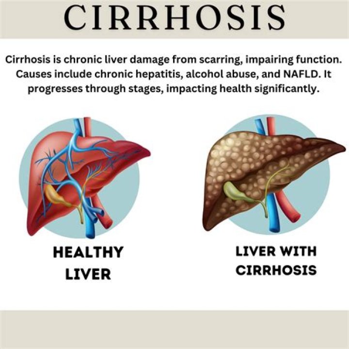 Does cirrhosis progress if you stop drinking?