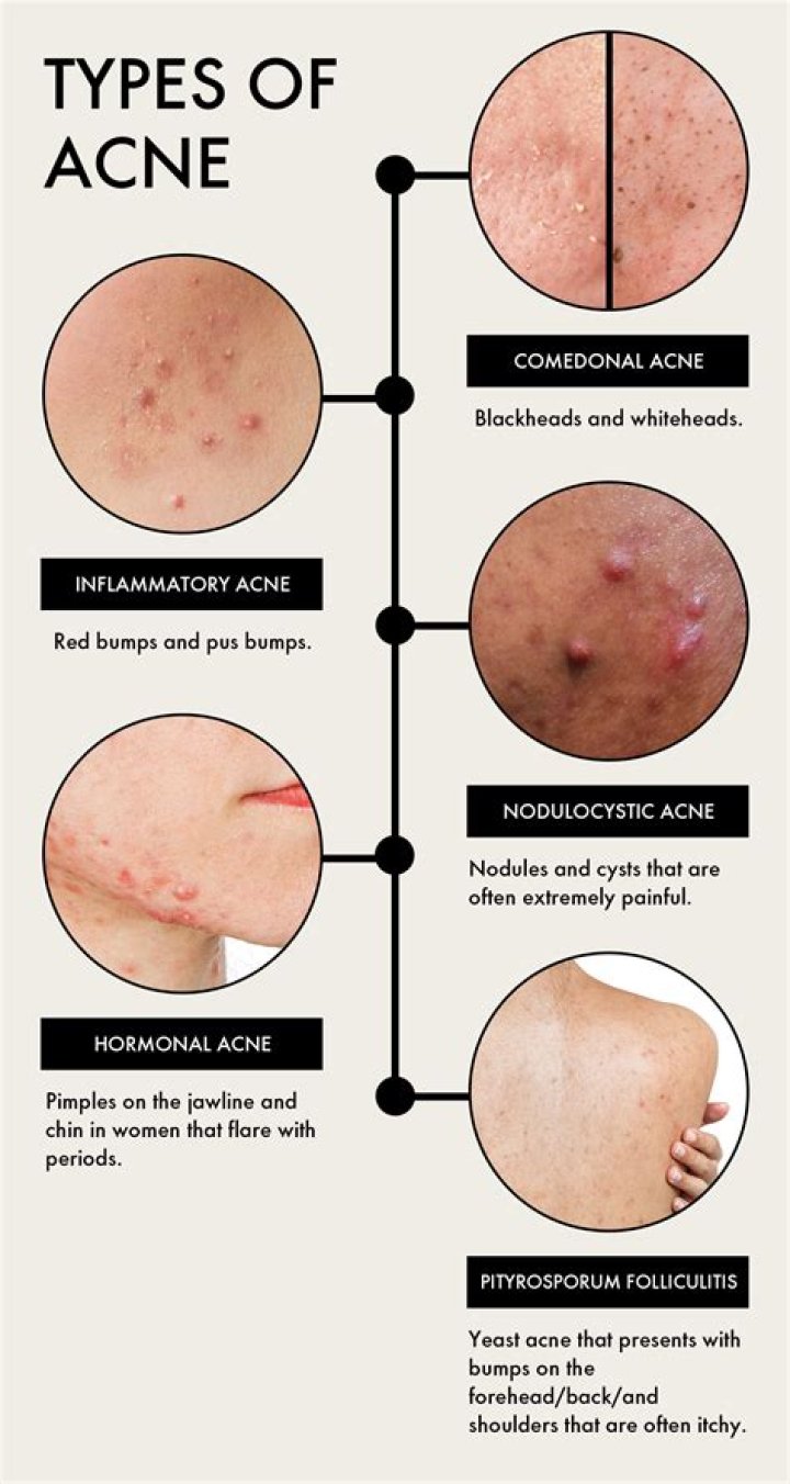 Does not sweating cause acne?