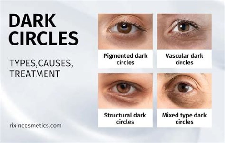 Does phone cause dark circles?