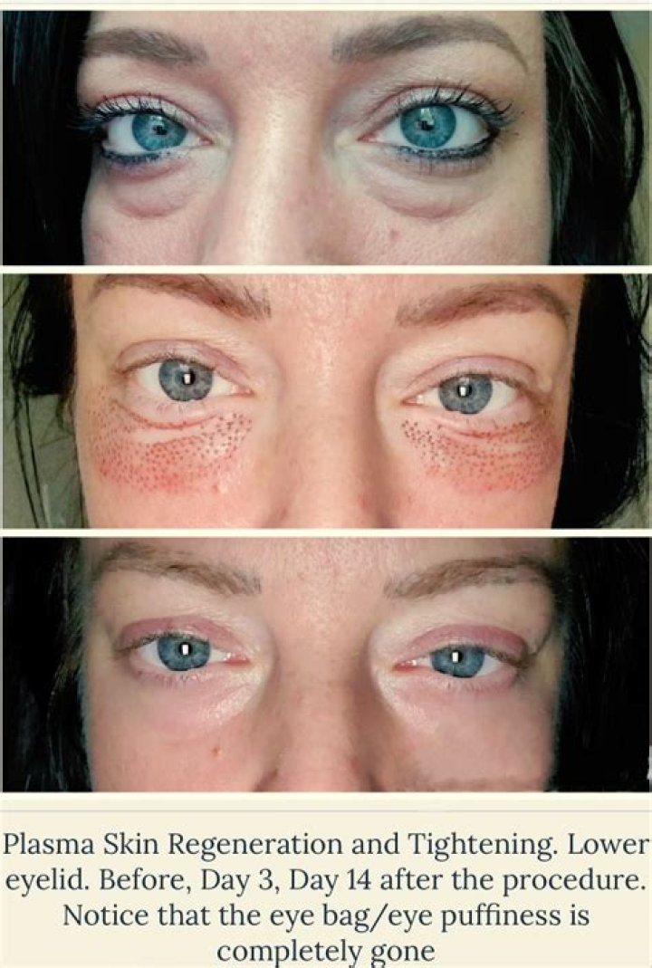 Does plasma pen work on scars?
