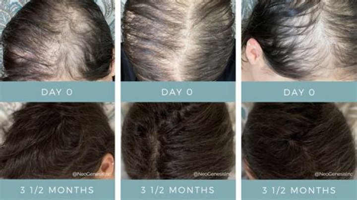 Does shower cause hair loss?