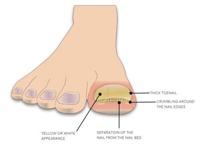 Does smoking affect your toenails?