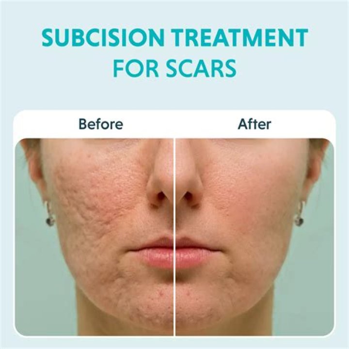 Does tanning fade scars?