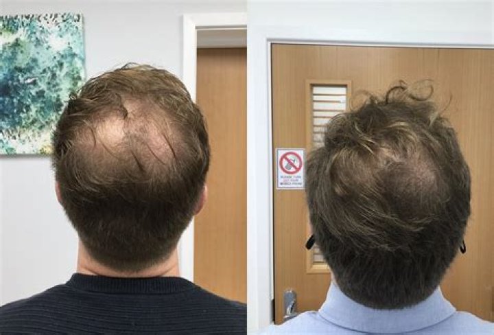 Does thinning hair still grow?