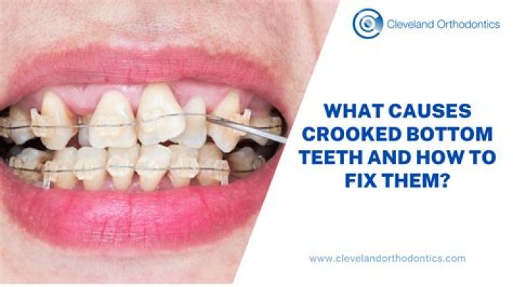 How can I look pretty with crooked teeth?
