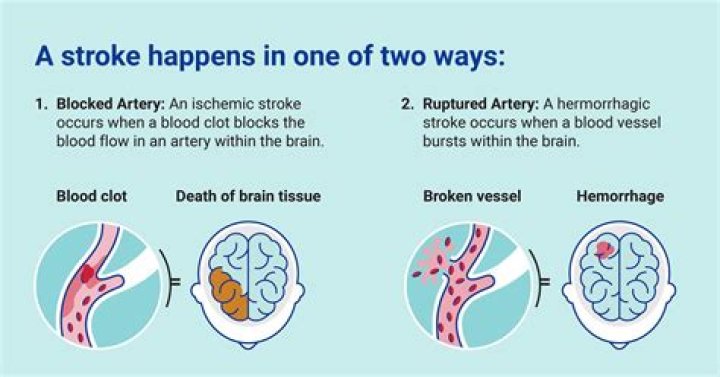 How can I rebuild my brain after a stroke?