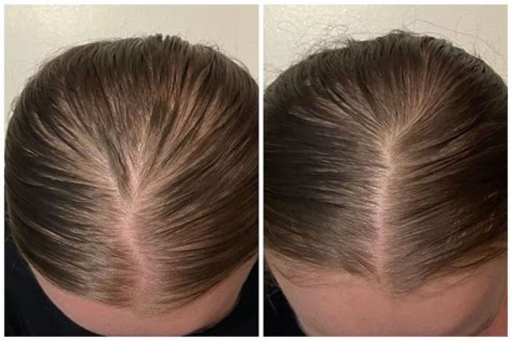How can I regrow my hair after chemical damage?