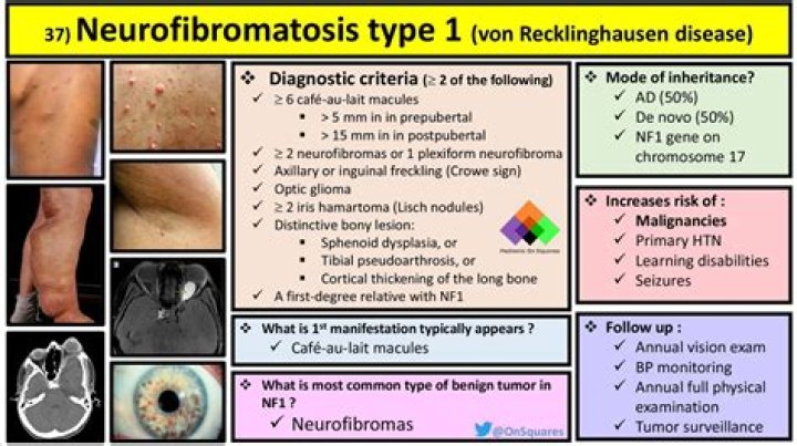 How do I know if I have neurofibromatosis type 2?