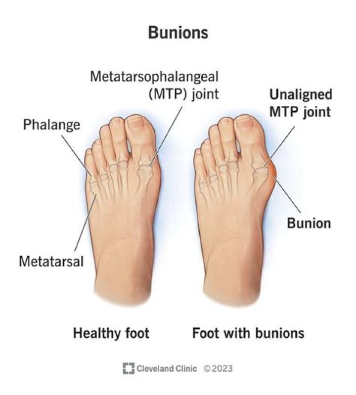 How do you get bunions to go away?