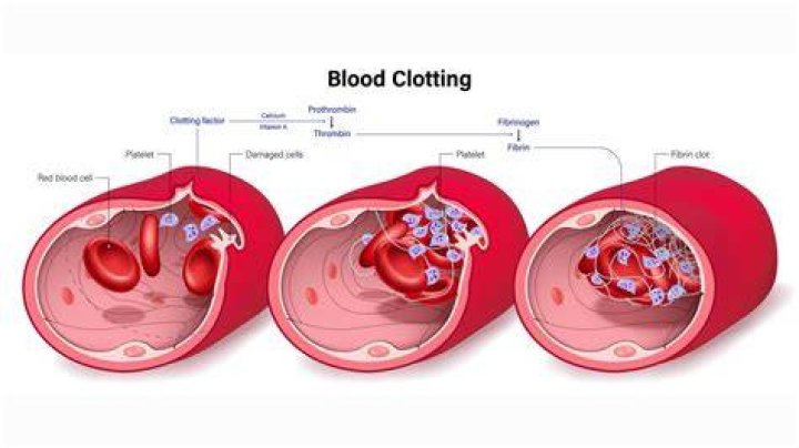 How do you prevent blood clots naturally?