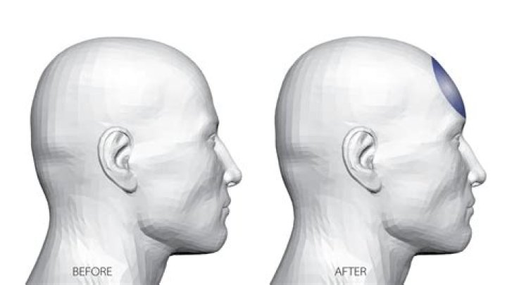 How do you reshape a skull?