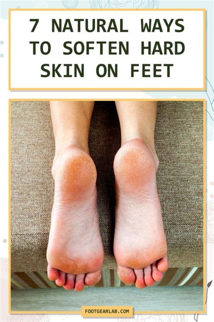 How do you soften hard skin from eczema?