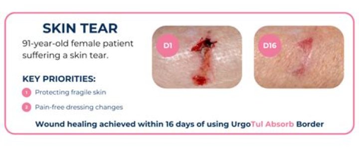 How do you treat a skin tear wound?