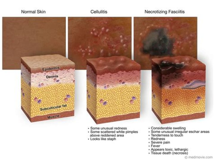 How does skin necrosis start?