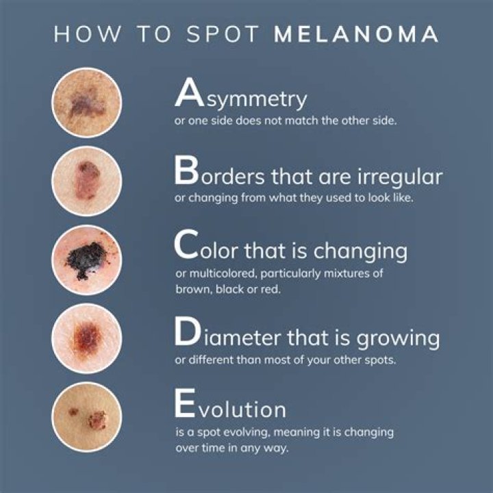 How long can you have melanoma before it kills you?