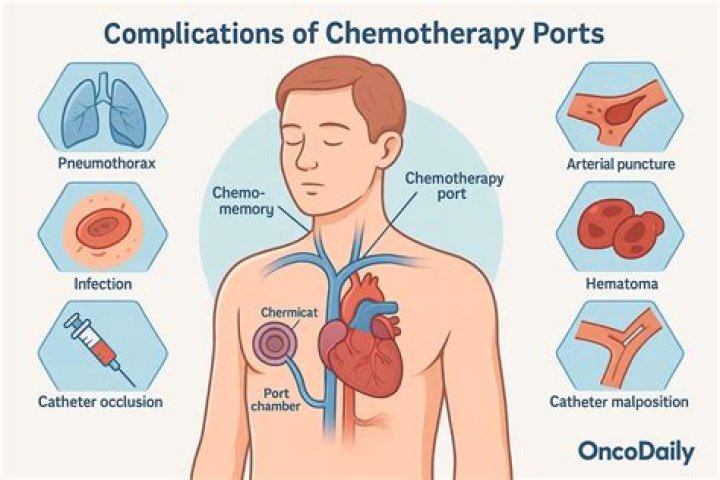 How long does it take for a chemo port to heal?