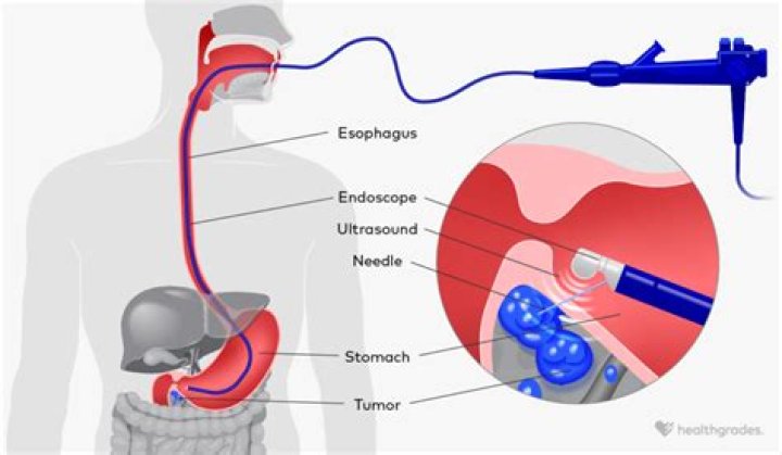 How long does your stomach hurt after an endoscopy?