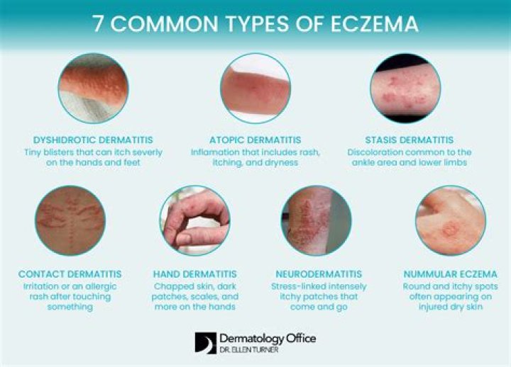 How often should you shower when you have eczema?