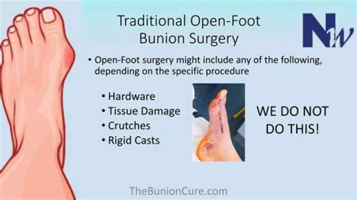 How painful is bunion surgery?